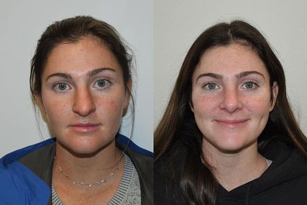 Closed Rhinoplasty Charleston SC