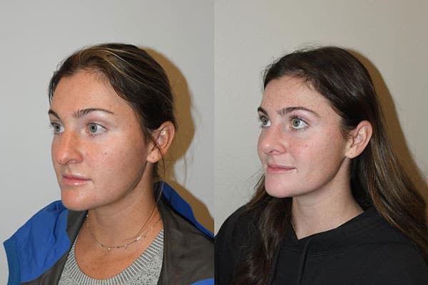 Best Closed Rhinoplasty Charleston