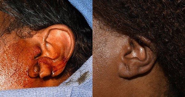 Earlobe Repair Before and After Photos