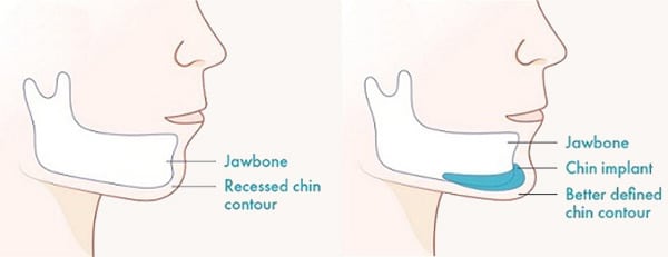Jaw Implant Surgery Illustration