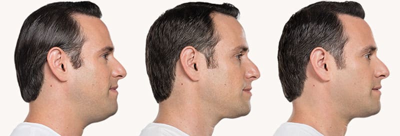 Kybella Neck Lift Before and After Photos