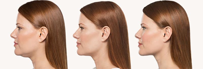 Kybella Neck Lift Photos