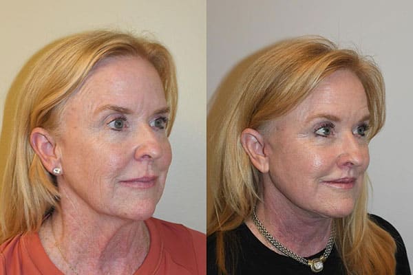 Laser Skin Resurfacing Before and After Photos