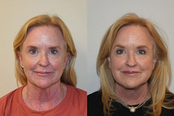 Laser skin-resurfacing-photos