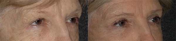 Lower Blepharoplasty Before and After