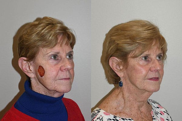 Best Mohs Before and After Patient Photos