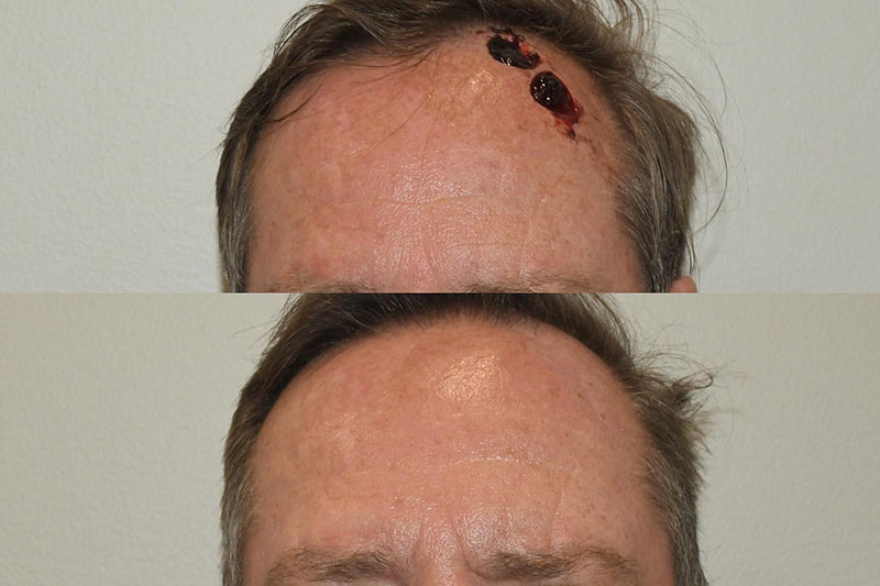 Mohs Reconstruction Surgery Forehead Photos