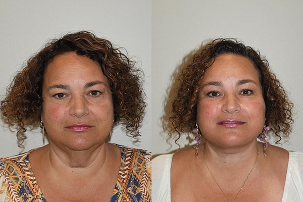 Neck Lift Patient Before and After Fronte View