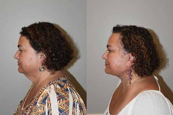 Neck Lift Patient Before and After Side View