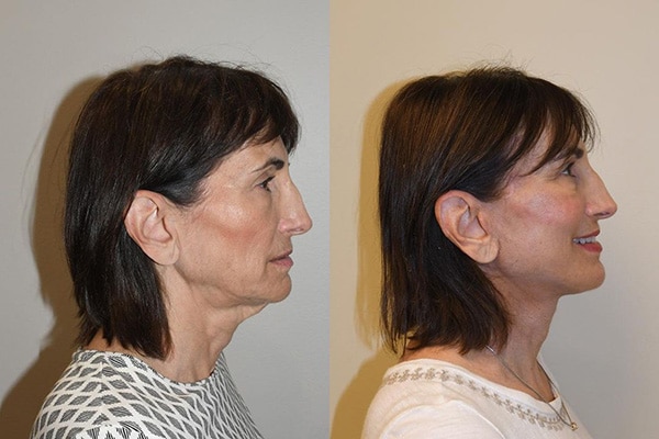 Necklift Before After Photos Side View