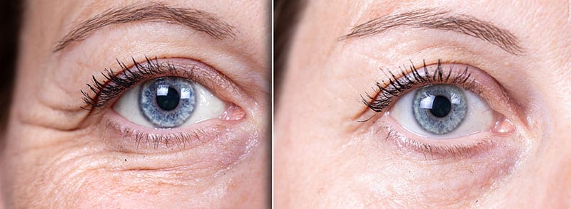 Non-Surgical Eyelid Lift Patient Photos