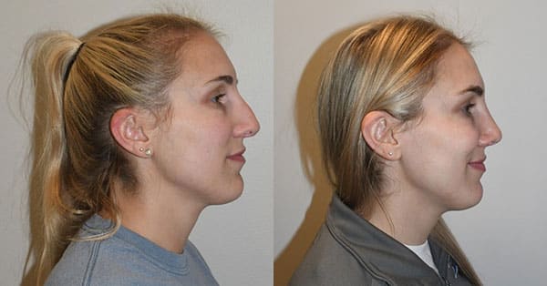 Open Rhinoplasty Before After Side View