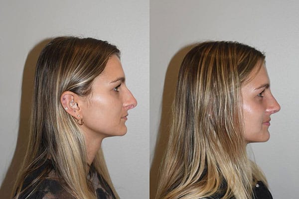 Open Rhinoplasty Charleston