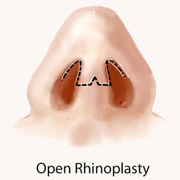 Open Rhinoplasty Diagram