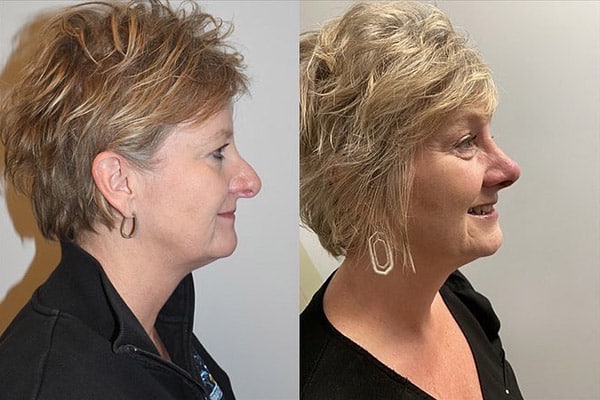 Revision Rhinoplasty Before and After Photos