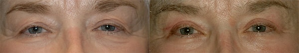 Upper Eyelid Before and After